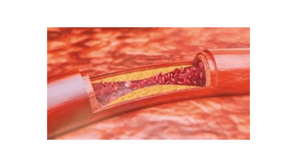 What are the 3 stages of atherosclerosis?