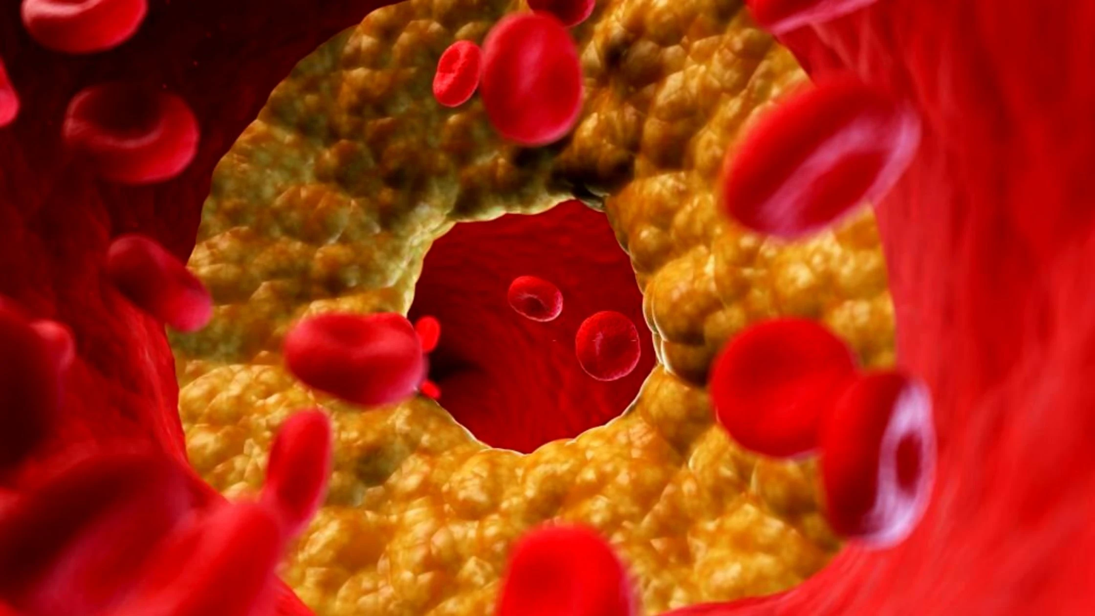 Know More About High Cholesterol