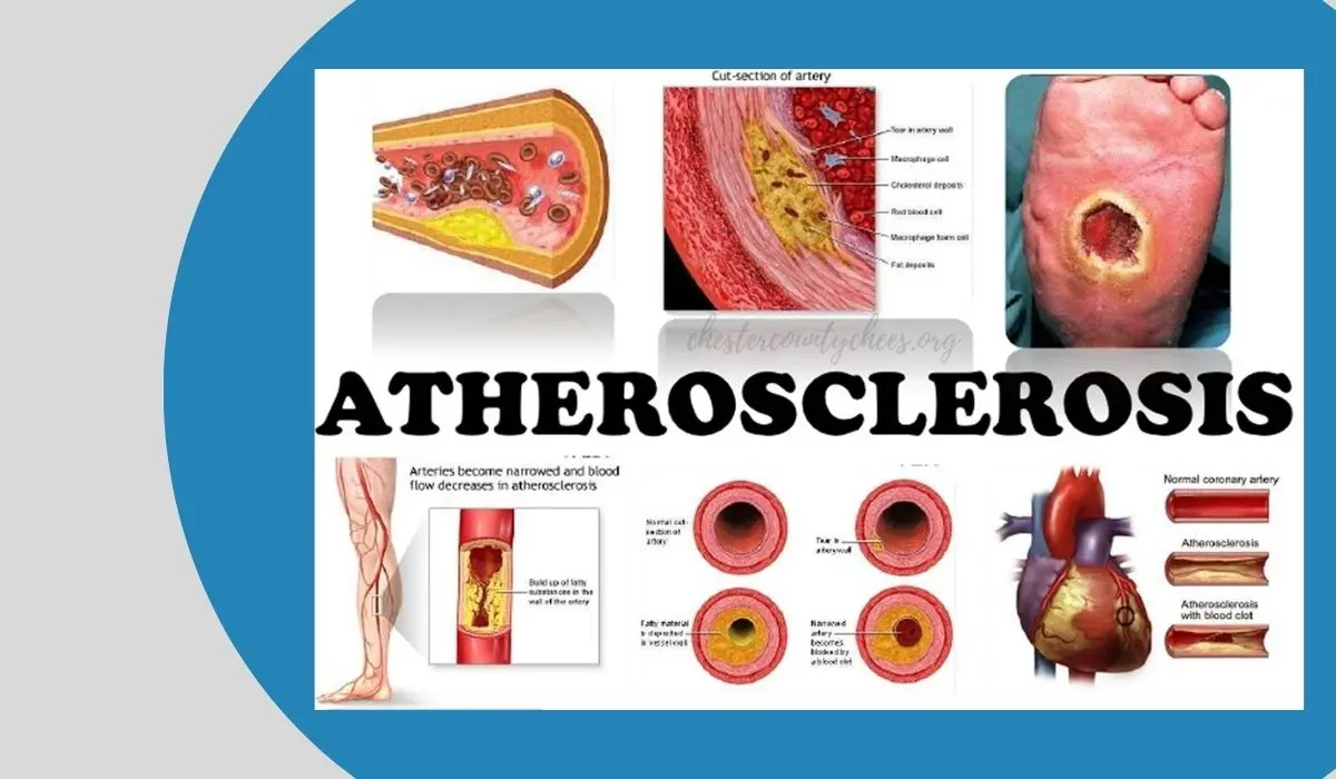 Atherosclerosis symptoms