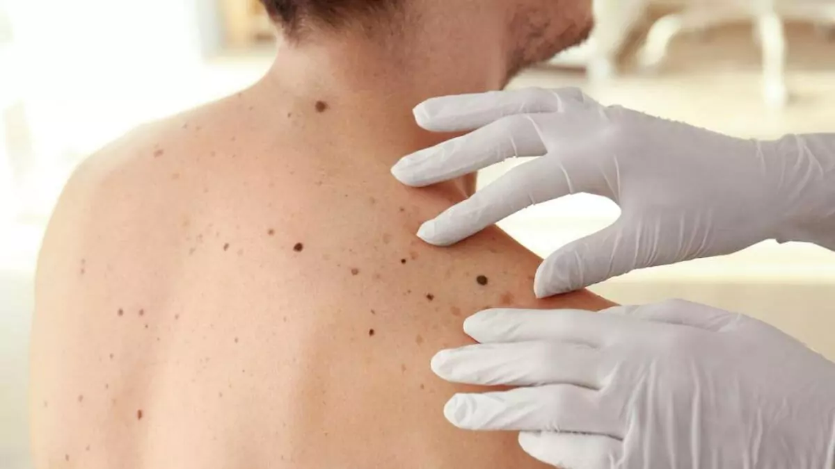 High Cholesterol Signs on your skin