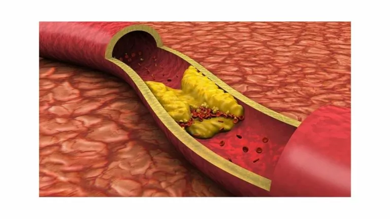 How High Cholesterol Affects Your Heart: Symptoms, Causes And Treatment!