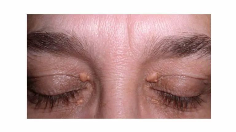 Cholesterol Bump On Eyelid – Causes, Prevention, And Remedies!