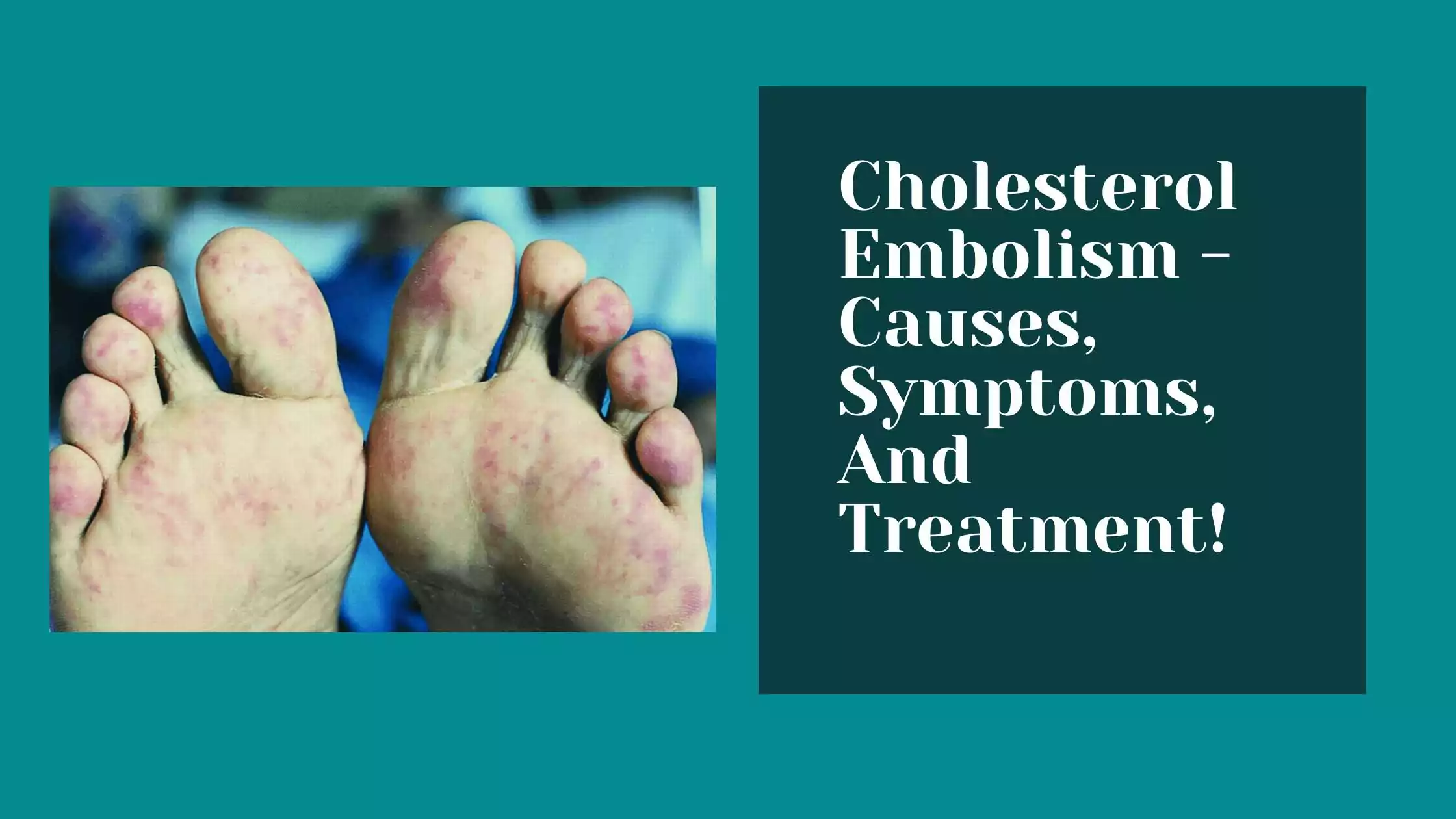 Cholesterol Embolism - Causes, Symptoms, And Treatment!