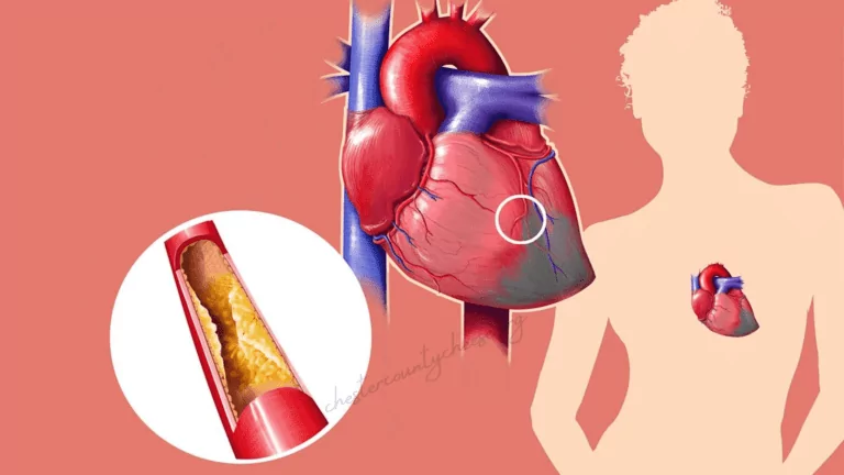 Does High Cholesterol Cause Heart Attack Or Stroke?