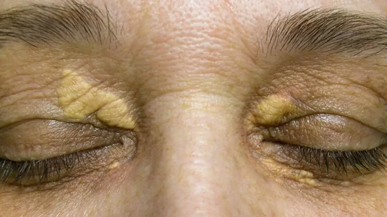 Xanthelasma: Are They Cholesterol Deposits Around Your Eyes?