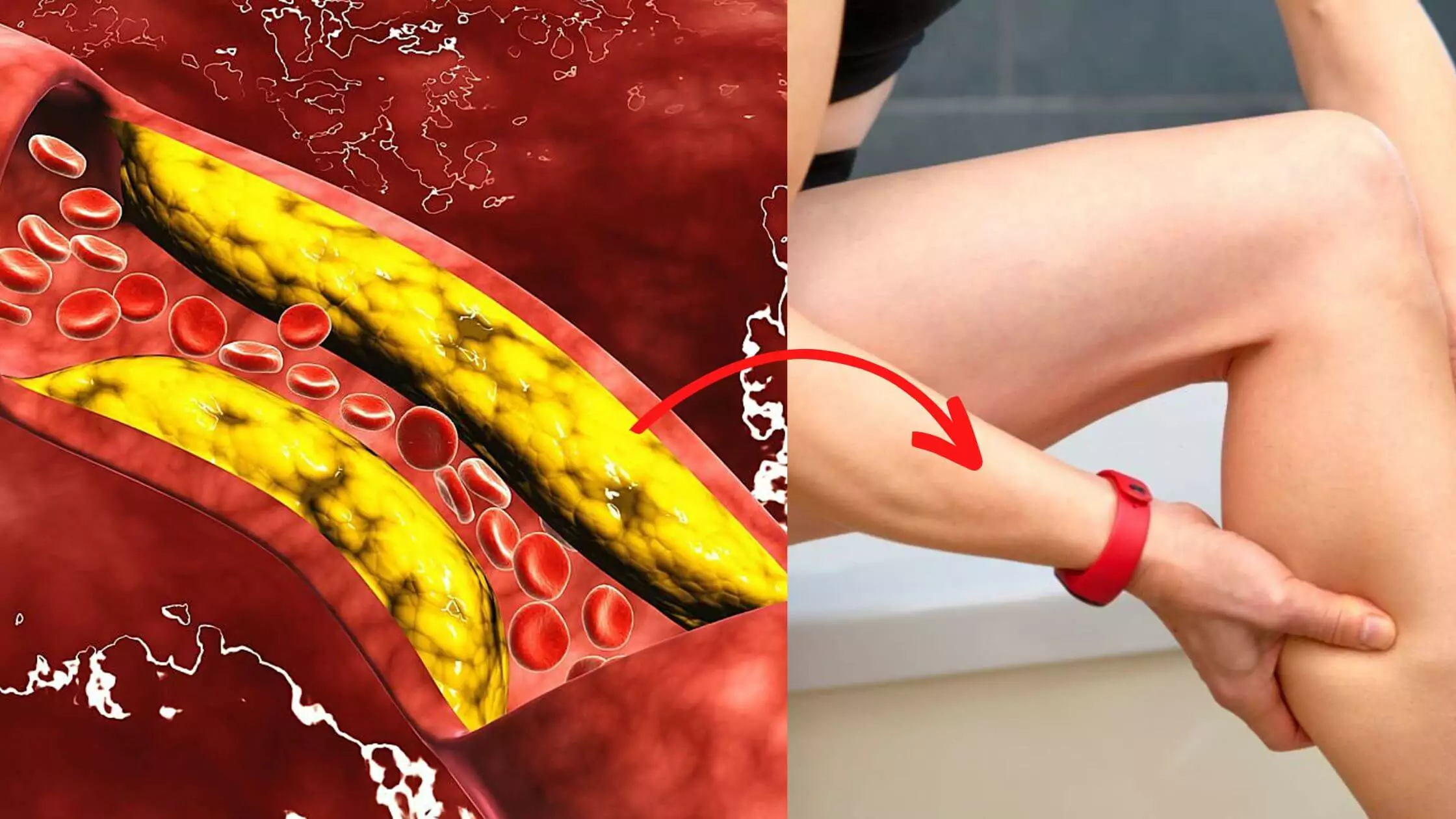 'Charley Horse' Is A Symptom Of Artery Clogging Caused By Cholesterol
